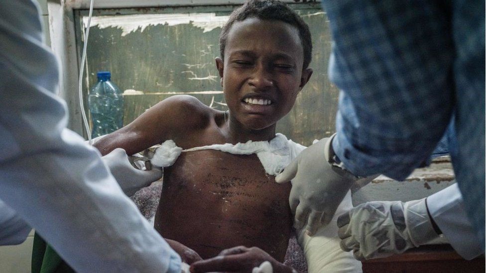 A Togoga injured residents, a village about 20km west of Mekele, where an alleged airstrike hit a market leaving an unknown number of casualties, receives medical treatments at the Ayder referral hospital in Mekele, the capital of Tigray region, Ethiopia, on June 23, 2021.