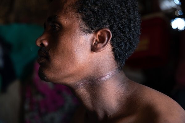 Ashenafi Hailu was attacked by a group of Fano militia members. After they learned that he was ethnic Tigray, they robbed him, tied a noose around his neck and dragged him until he passed out.